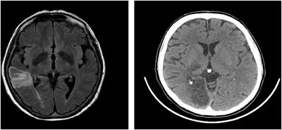 Travel Planning Ability in Right Brain-Damaged Patients: Two Case Reports